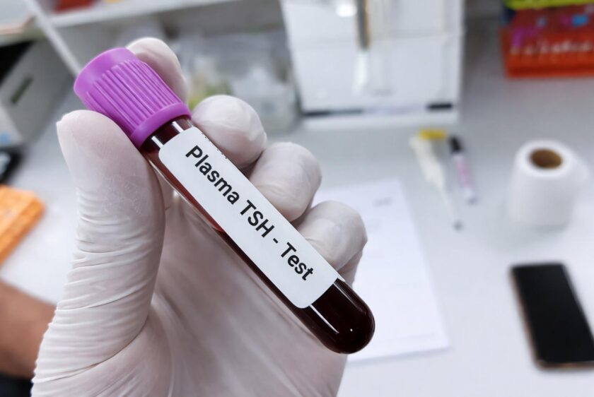 TSH analiz nə üçün verilir