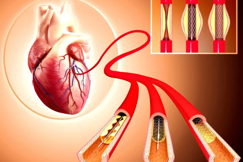 ürəkdə stent əməliyyatı