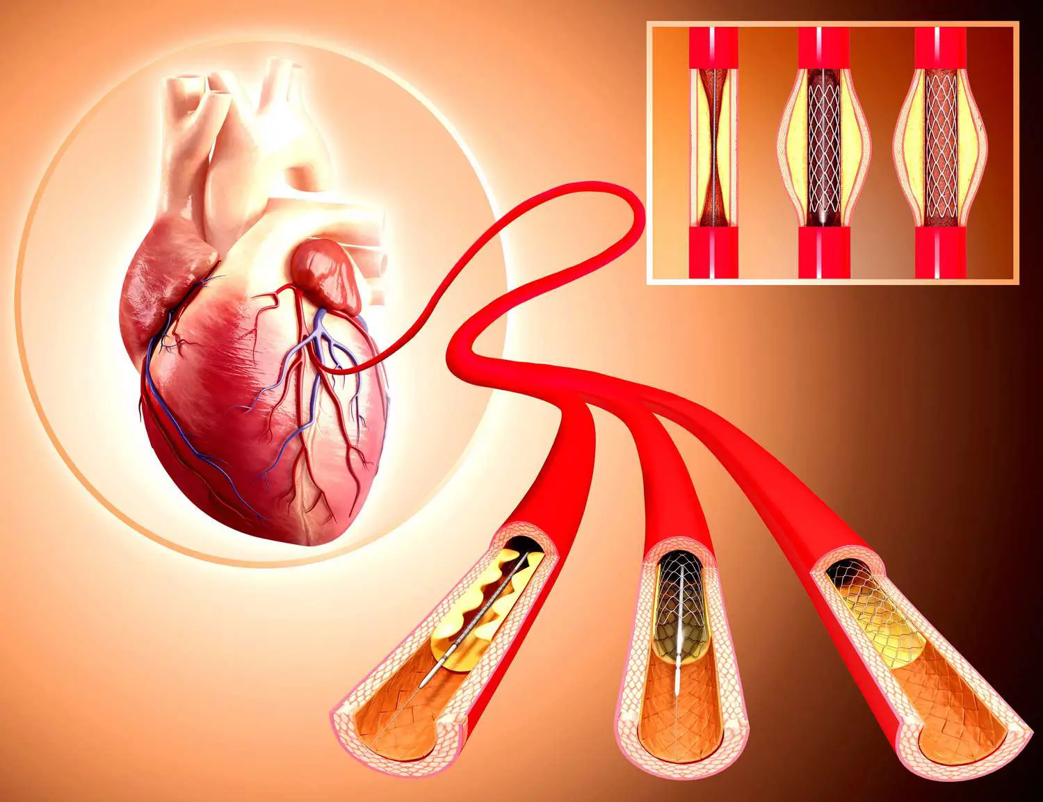 ürəkdə stent əməliyyatı