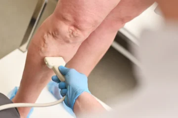 ayaqda varikoz əlamətləri