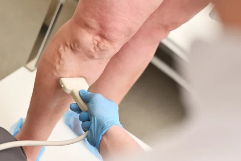 ayaqda varikoz əlamətləri